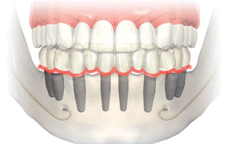 Dentadura Fixa
